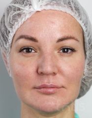 Результати Набір TESSLIFT SOFT V-DERM (10 ниток) + Бандаж + канюля SoftFil 18G 70mm + 18G*40mm голка  фото после #2