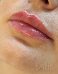 Результати Saypha Filler Lidocaine NEW  фото после #2