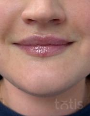 Rezultate Aileene Vol.2 +Lido 1ml*1шприц  фото после #2