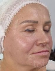 Результати Facetem S 1,5 ml  фото после #2