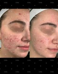 Результаты Rosacea Relief NEW  фото до #1