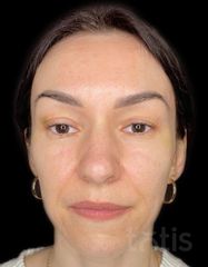Результати Facetem S 1,5 ml  фото до #1