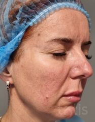 Výsledky Facetem S 0.8mlx2  фото до #1