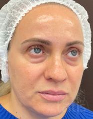 Výsledky Facetem S 0.8mlx2  фото до #1