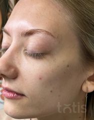 Результаты 640 Lift'Expert Serum  фото после #2
