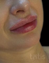 Результати Saypha Filler Lidocaine NEW  фото после #2