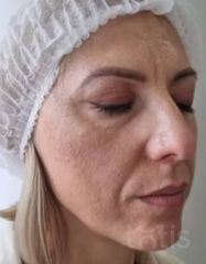 Rezultate Facetem S 0.8ml * 1 seringă  фото до #1