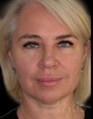 Rezultate Facetem S 0.8ml * 1 seringă  фото после #2