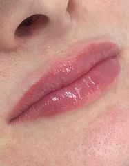 Результати Saypha Filler Lidocaine NEW  фото после #2