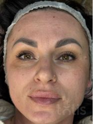 Результаты Professional Peptide Perfection Exfoliator  фото до #1