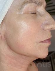 Результати Professional Tightening Protein Booster  фото после #2