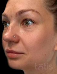 Rezultaty Saypha Volume Lidocaine NEW  фото до #1
