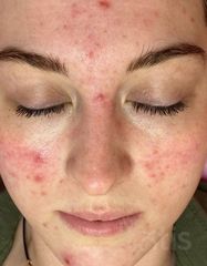 Результаты PURE Acne Cream  фото до #1