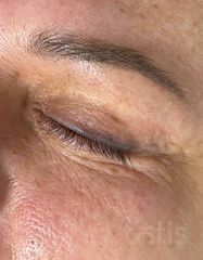 Результаты ULTIMATE EYE CORRECTOR  фото после #2