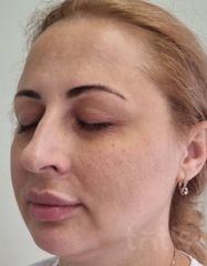 Výsledky Facetem S 0.8mlx2  фото до #1