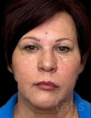 Rezultate Facetem S 0.8ml * 1 seringă  фото после #2