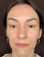 Rezultate Facetem S 0.8ml * 1 seringă  фото до #1