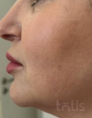 Результати Набір TESSLIFT SOFT V-DERM (10 ниток) + Бандаж + канюля SoftFil 18G 70mm + 18G*40mm голка  фото после #2