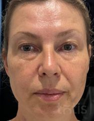 Результати Набір TESSLIFT SOFT V-DERM (10 ниток) + Бандаж + канюля SoftFil 18G 70mm + 18G*40mm голка  фото после #2