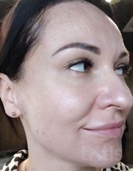Результаты Glycolic Facial Cleanser with 10% Glycolic Acid  фото после #2
