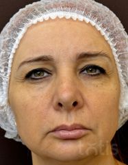 Результати Набір TESSLIFT SOFT V-DERM (10 ниток) + Бандаж + канюля SoftFil 18G 70mm + 18G*40mm голка  фото после #2