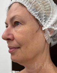 Результати Набір TESSLIFT SOFT V-DERM (10 ниток) + Бандаж + канюля SoftFil 18G 70mm + 18G*40mm голка  фото до #1