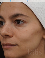 Výsledky Acnoderm Gel  фото после #2