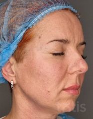 Результати Facetem S 1.5ml *1 шт. + конектор  фото после #2