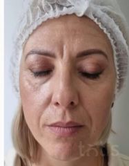 Rezultate Facetem S 0.8ml * 1 seringă  фото до #1