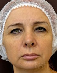 Результаты Набор TESSLIFT SOFT V-DERM (10 нитей) + Бандаж + канюля SoftFil 18G 90mm + 18G*40mm игла  фото после #2