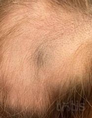 Результаты HAIR LOSS CONTROL  фото до #1