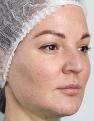 Результати Набір TESSLIFT SOFT V-DERM (10 ниток) + Бандаж + канюля SoftFil 18G 70mm + 18G*40mm голка  фото после #2