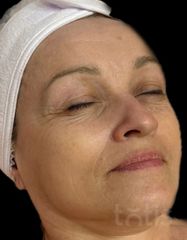Результаты Collagen Fleece Mask Fruit Acid  фото после #2
