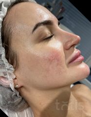 Результати 3080 [SKIN] BIOSIS PROFESSIONAL MASK  фото после #2