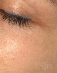Результати Whitening De Pigmentor Serum  фото после #2