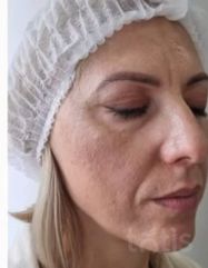 Результати AGE RESCUE 24H CREAM  фото до #1