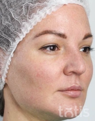 Rezultaty Zestaw TESSLIFT SOFT V-DERM (10 nici) + Bandaż + kaniula SoftFil 18G 70mm + igła 18G  фото после #2