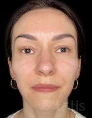 Результати Facetem S 1,5 ml  фото после #2
