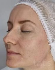 Результати EPIGEN AGE PERFECTION SERUM  фото после #2