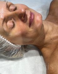 Результаты 650 Lift'Expert Wrinkle Smoother  фото после #2