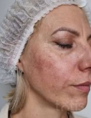 Результати AGE RESCUE 24H CREAM  фото после #2
