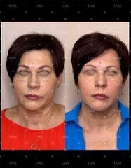 Rezultaty Facetem S 0.8Mlx2  фото до #1