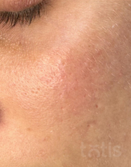 Rezultaty Fruit Acid Aha Toner  фото до #1