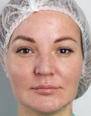 Результаты Набор TESSLIFT SOFT V-DERM (10 нитей) + Бандаж + канюля SoftFil 18G 90mm + 18G*40mm игла  фото после #2