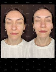 Rezultaty Facetem S 0.8Mlx2  фото до #1