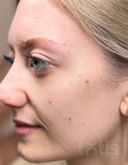 Результаты 640 Lift'Expert Serum  фото до #1