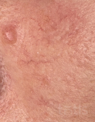 Результати Sanvita® Gel  фото до #1