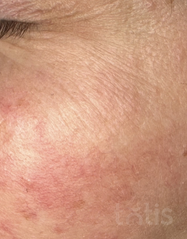 Результаты Anti Couperose Cream  фото после #2