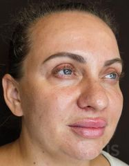 Rezultate Facetem S 0.8ml * 1 seringă  фото после #2
