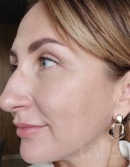Результати Professional Peptide Perfection Exfoliator  фото до #1